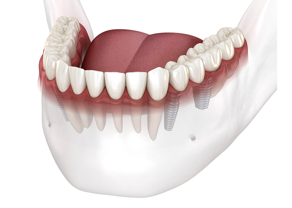 最終補綴物（ジルコニア）の装着