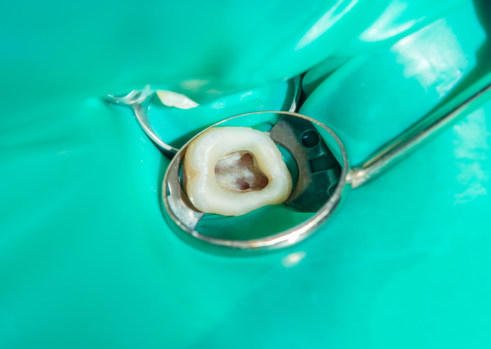 「無菌化」をめざす根管治療