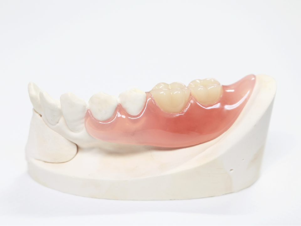 ノンクラスプ義歯