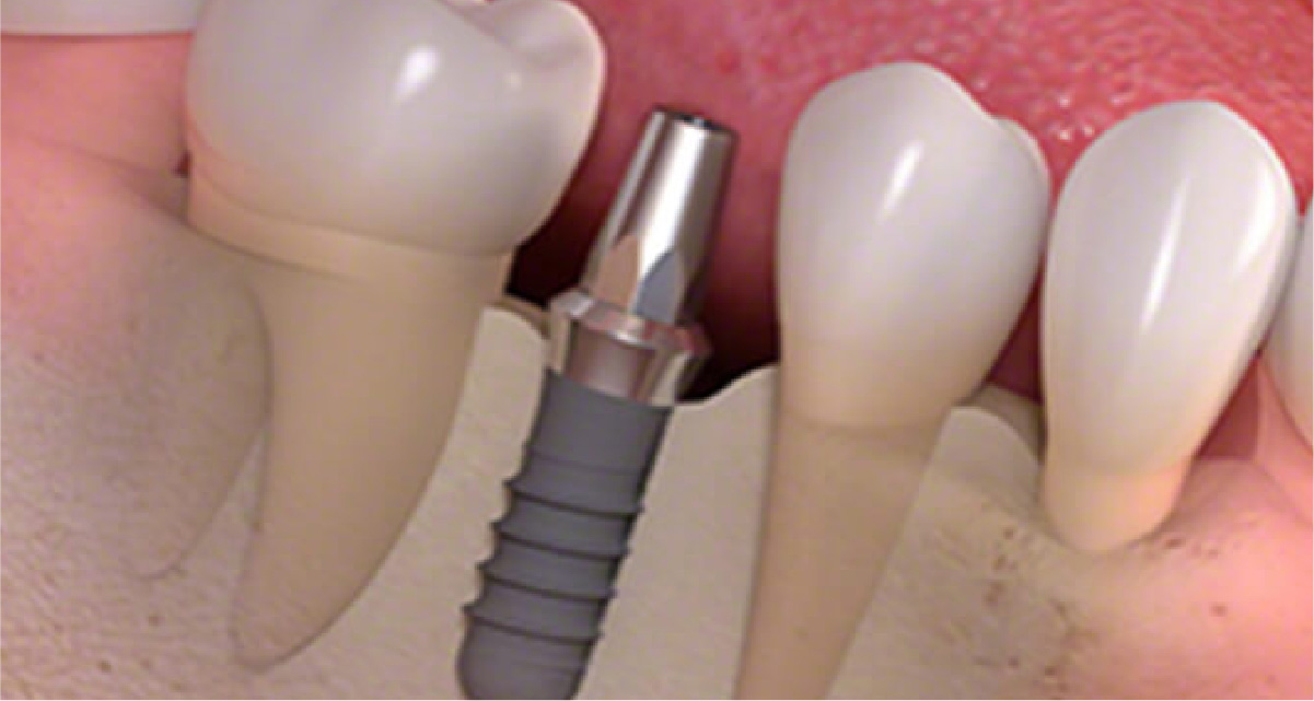 アバットメントの装着