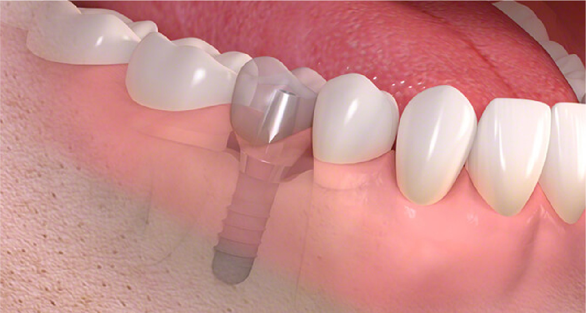  歯の型取り、仮歯の装着
