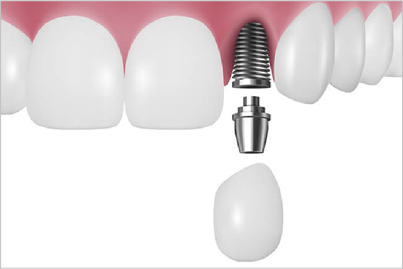 インプラントの主なメリット