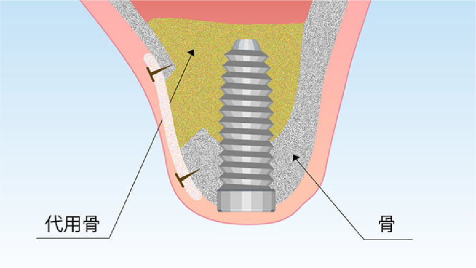サイナスリフト