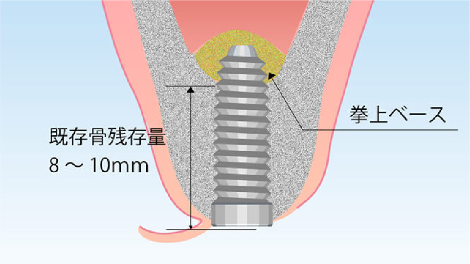 ソケットリフト