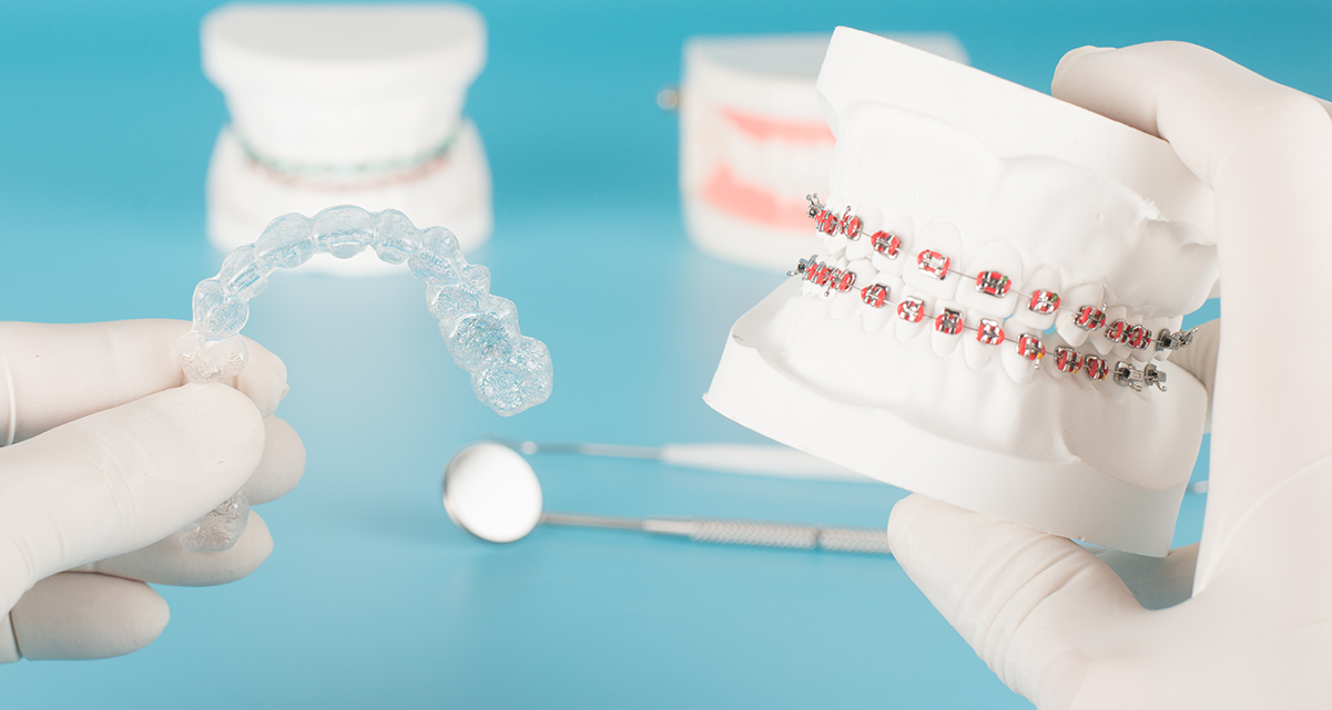 金属アレルギーの心配がない