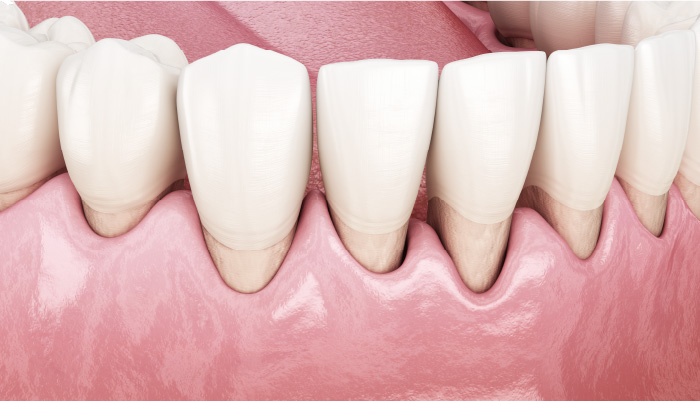 歯周病の症状について