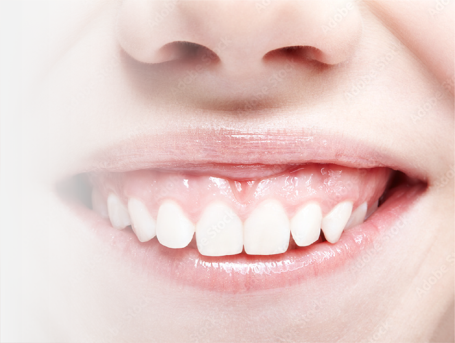 ガミースマイル