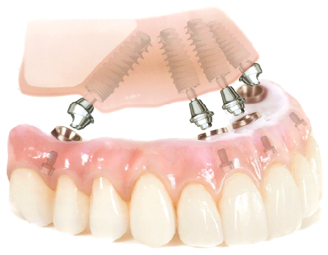インプラントオーバーデンチャー
