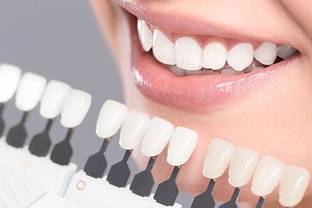 オフィスホワイトニング