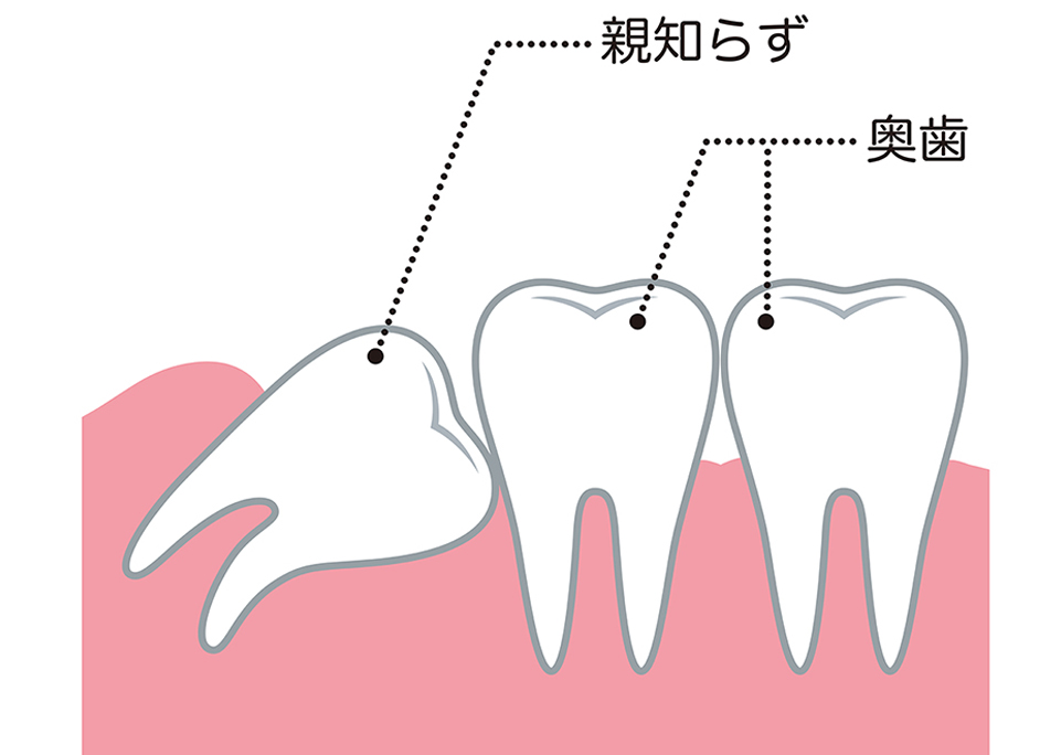 親知らずとは？