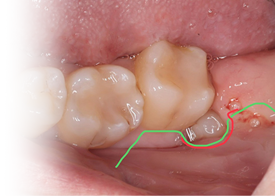 歯ぐきの切開線