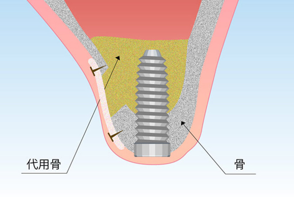 骨の量に問題がある場合も可能