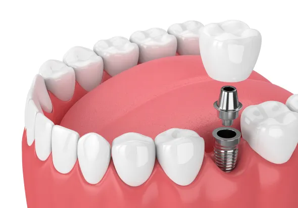 インプラント治療の比較写真