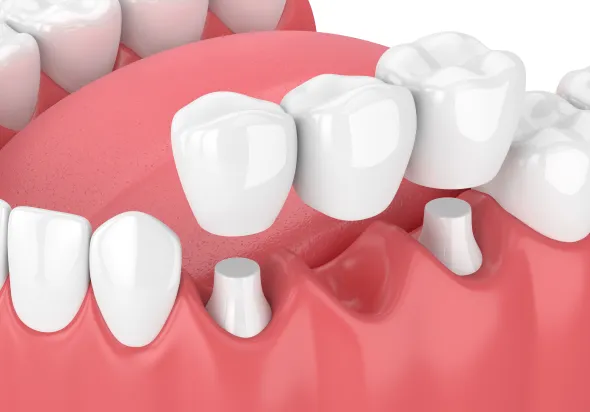 ブリッジの比較写真