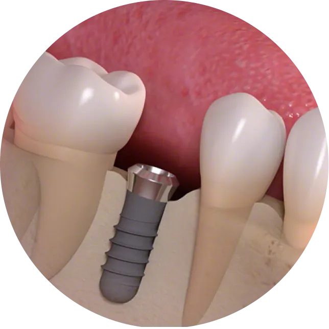 インプラント埋入手術