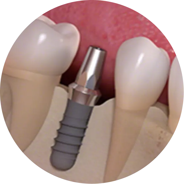 アバットメント装着