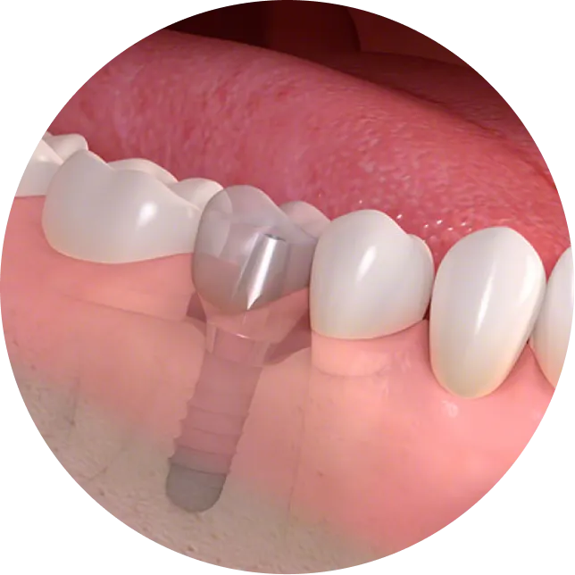 上部構造（人工歯）装着