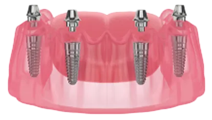 All-on-4インプラント体