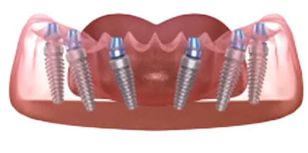 All-on-6インプラント体