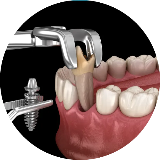 インプラント治療の写真