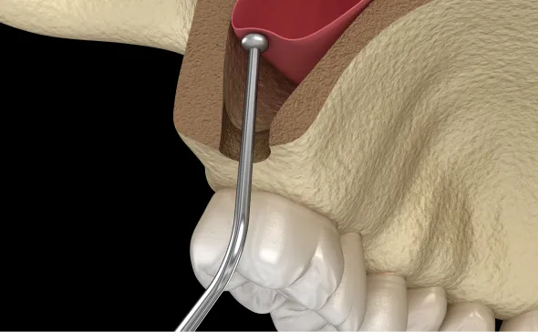 ソケットリフト治療