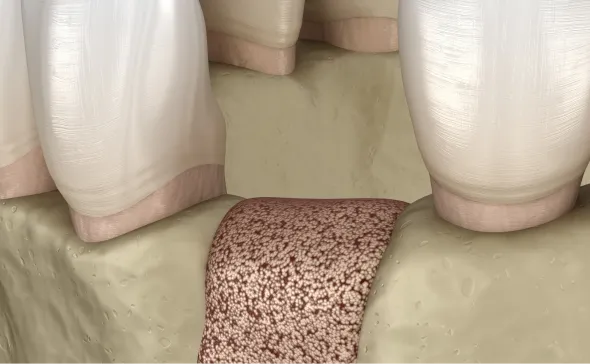 GBR（骨誘導再生）治療