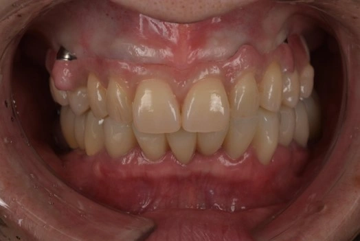 オールオン４　症例③