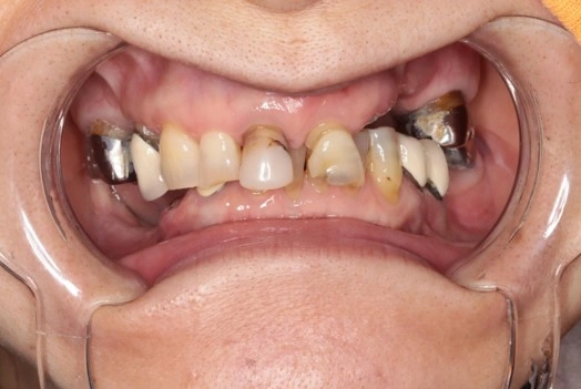 オールオン４　症例②