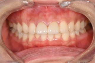 前歯2本のセラミック治療　症例③