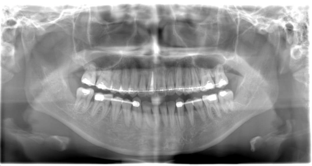 親知らず抜歯　症例③