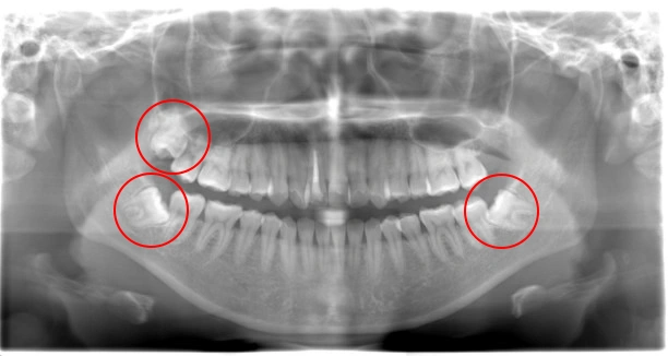 親知らず抜歯　症例②